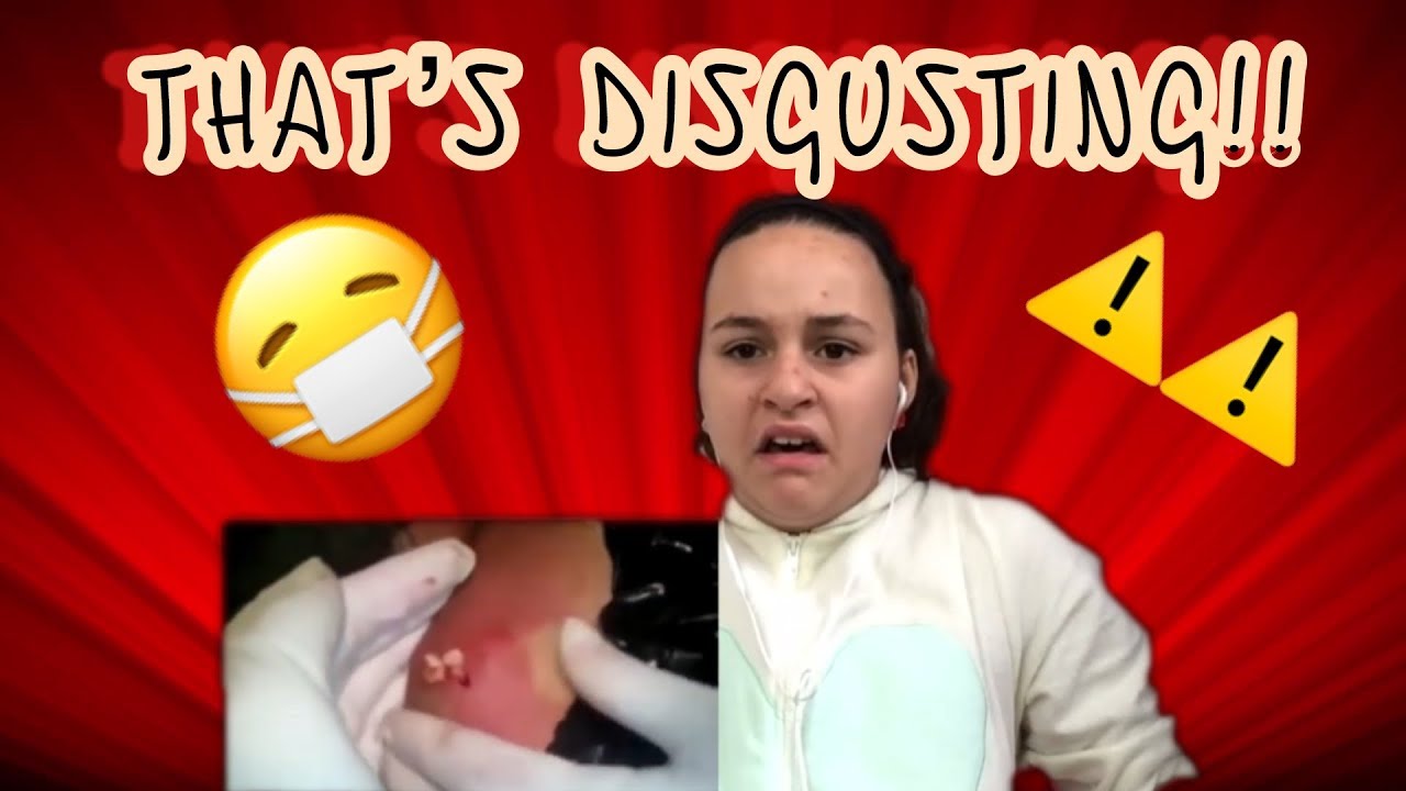 DISGUSTING PIMPLE POPPING! REACTION!