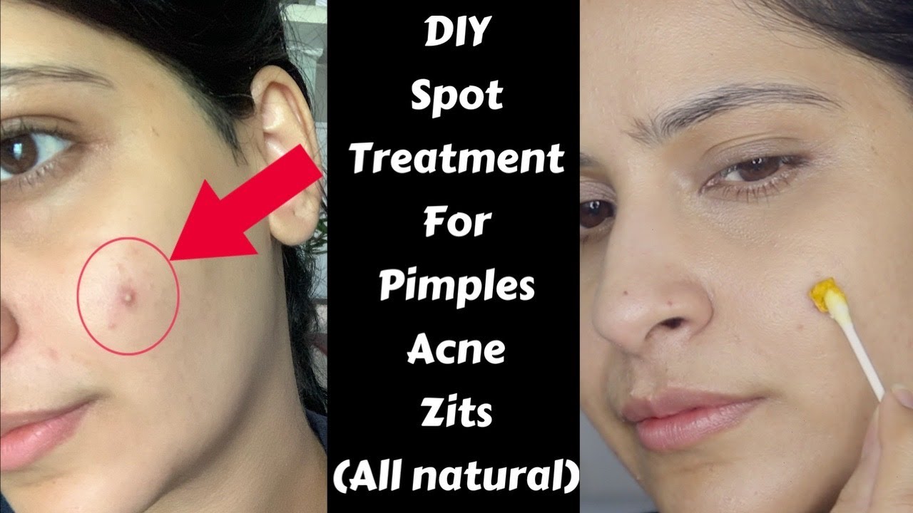 DIY Spot Treatment For Pimples, Zits & Acne | How to get rid of pimples & acne fast