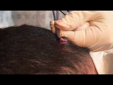 Doctor popping and removing a Cyst from Patient's Head **WARNING GRAPHIC**