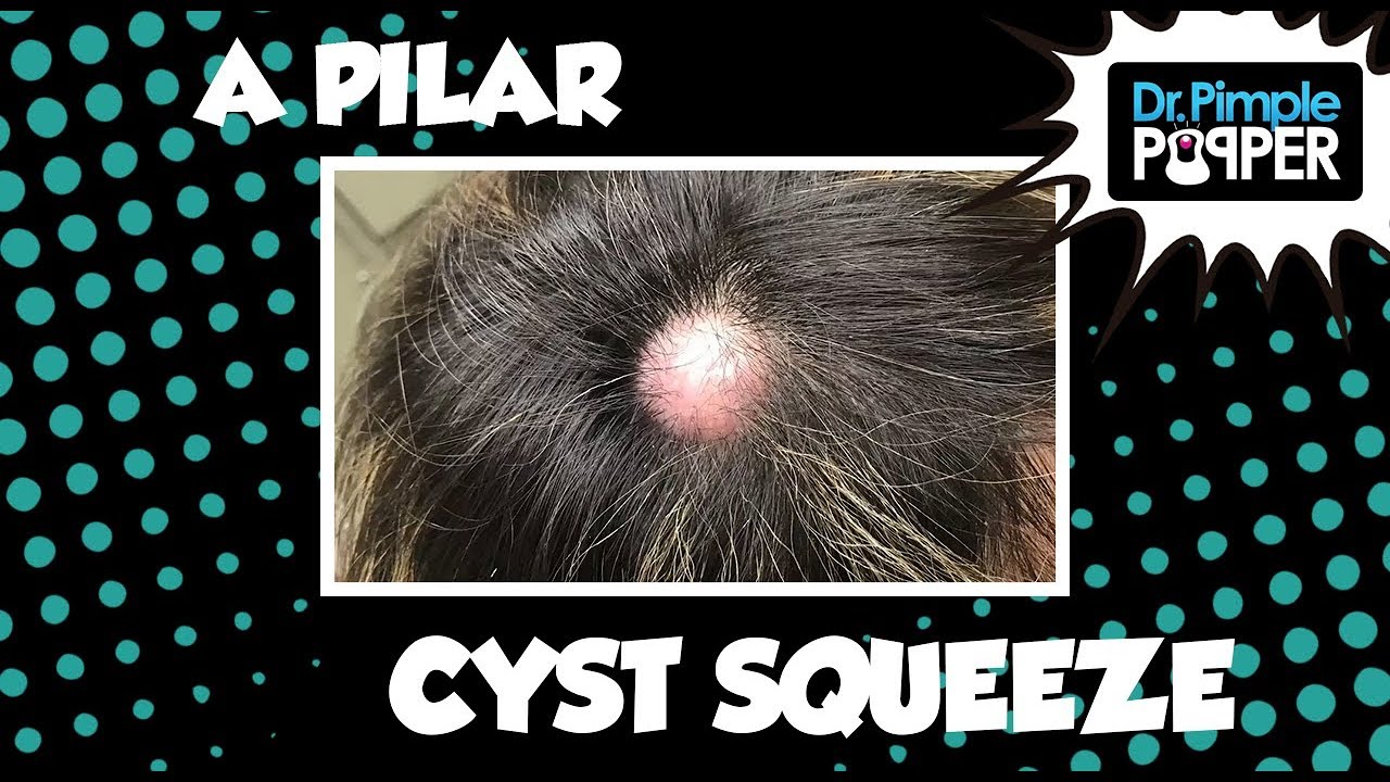 Don’t Be Cyst Averse…Embrace the Popping