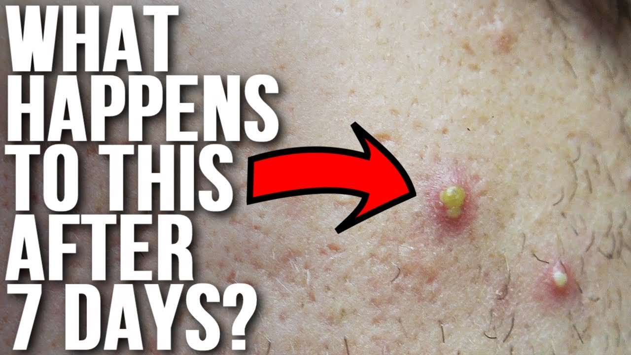 Don’t Touch Your Acne & See What Happens!