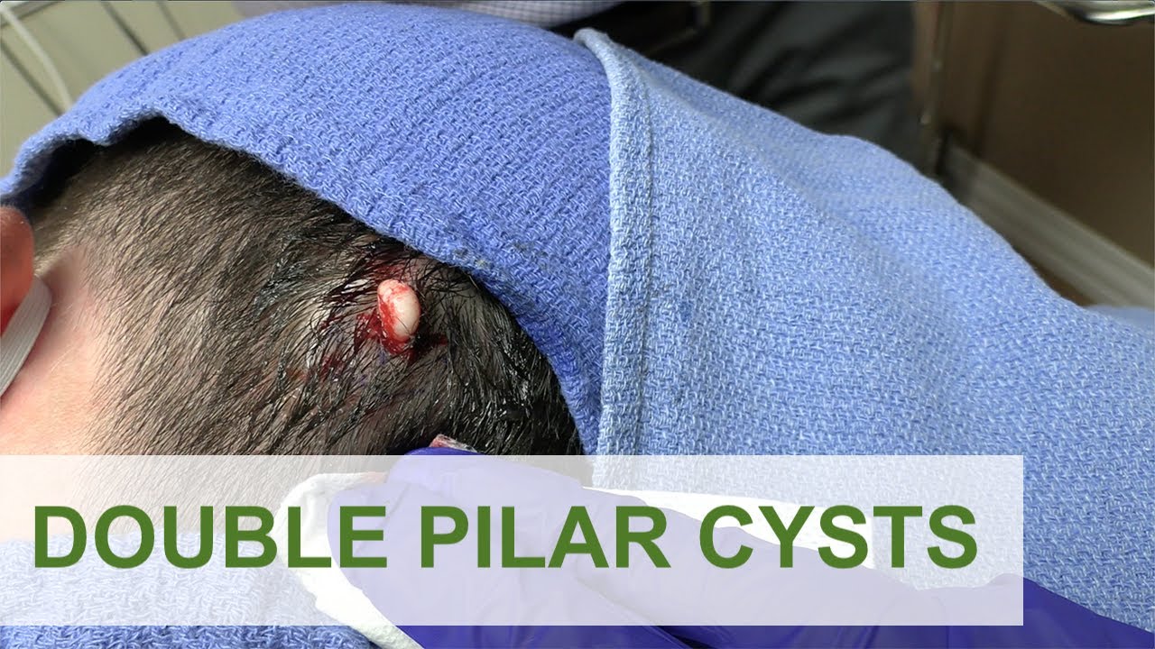 Double Pilar Cysts | Dr. Derm
