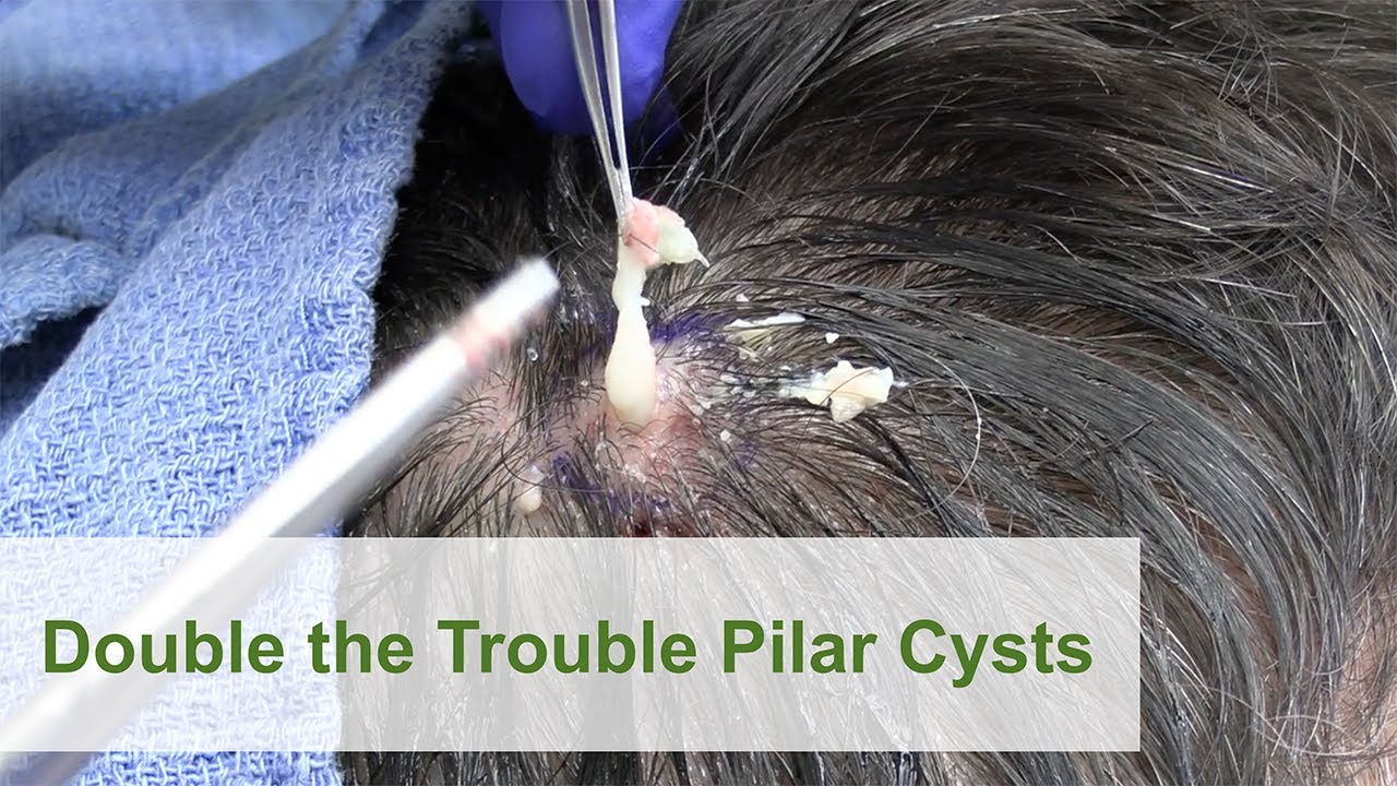 Double the Trouble Pilar Cysts | Dr. Derm
