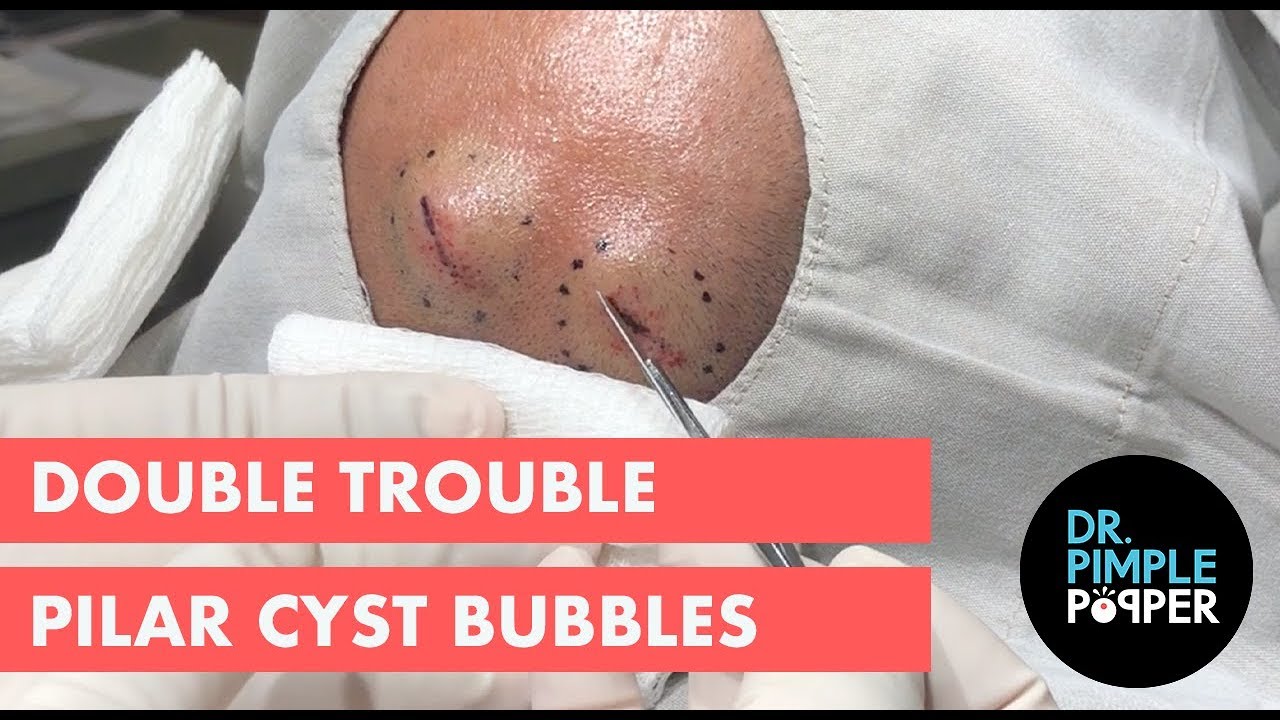 Double Trouble Pilar Cyst Bubbles