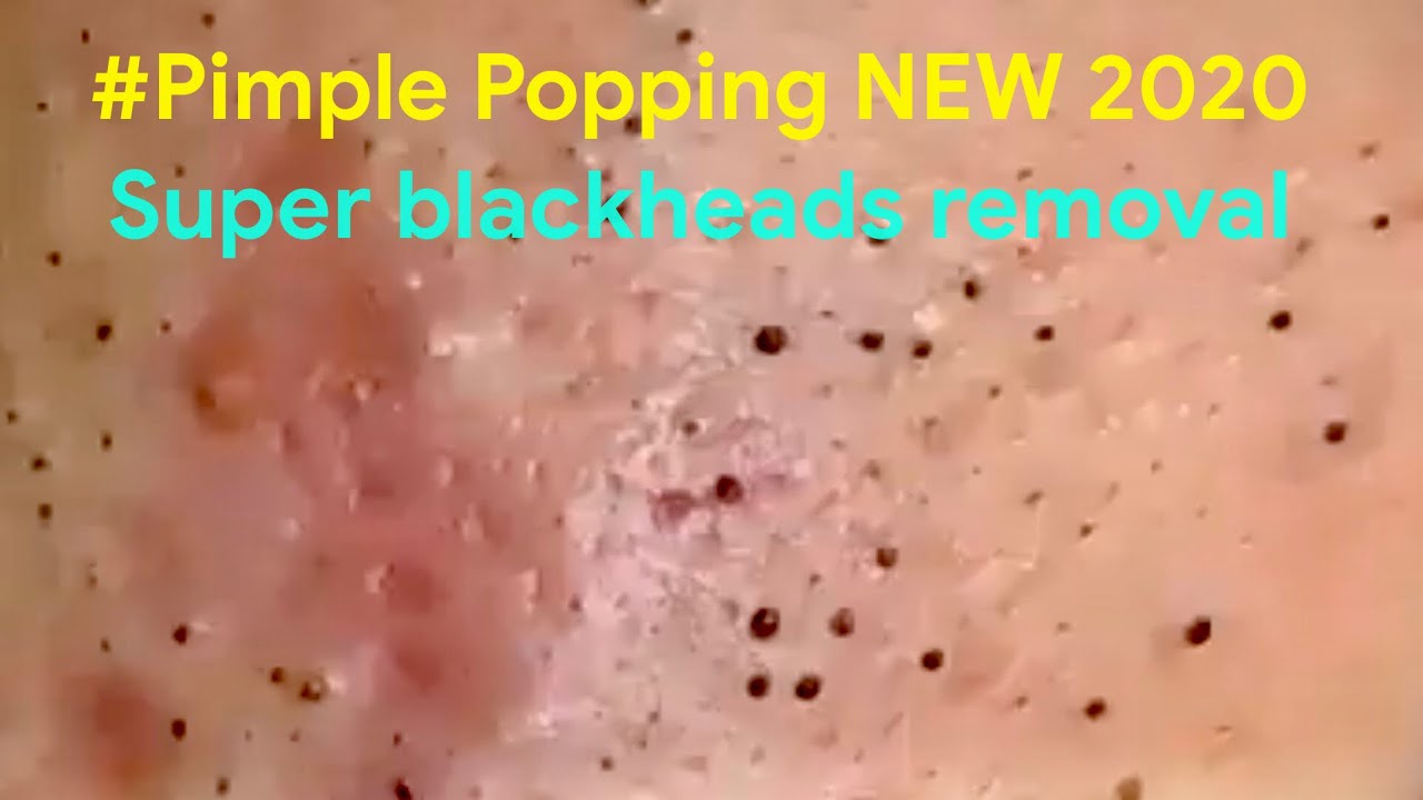 Dr Acne Treatment #02| Pimple Popping 2020| Blackheads, Whiteheads & Inflamed removal
