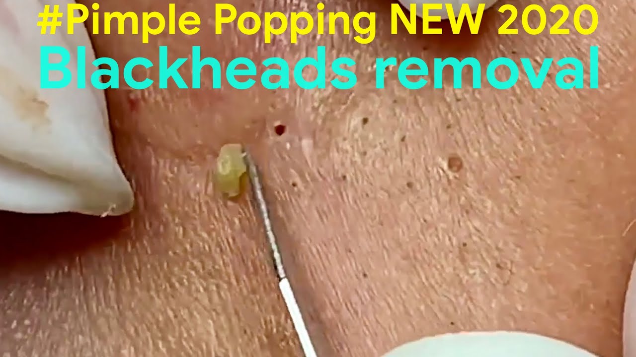 Dr Acne Treatment #03| Pimple Popping 2020| Blackheads, Whiteheads & inflamed removal