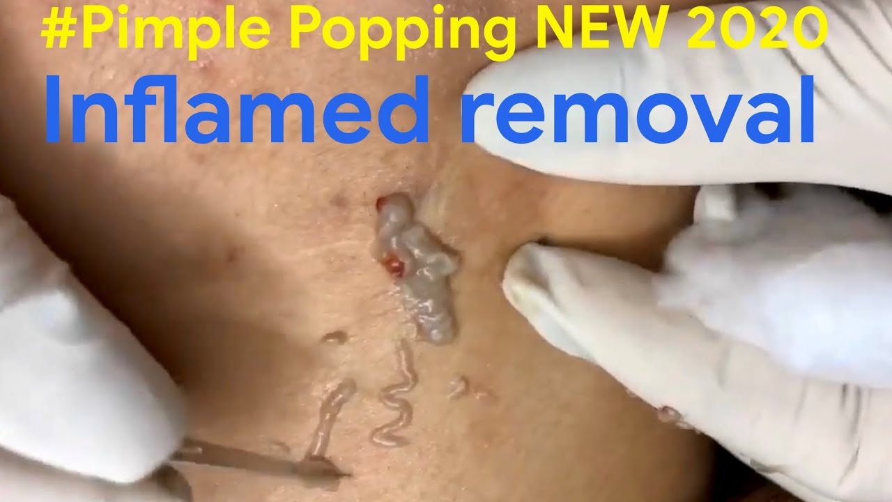 Dr Acne Treatment #04| Pimple Popping 2020| Blackheads, Whiteheads & inflamed removal