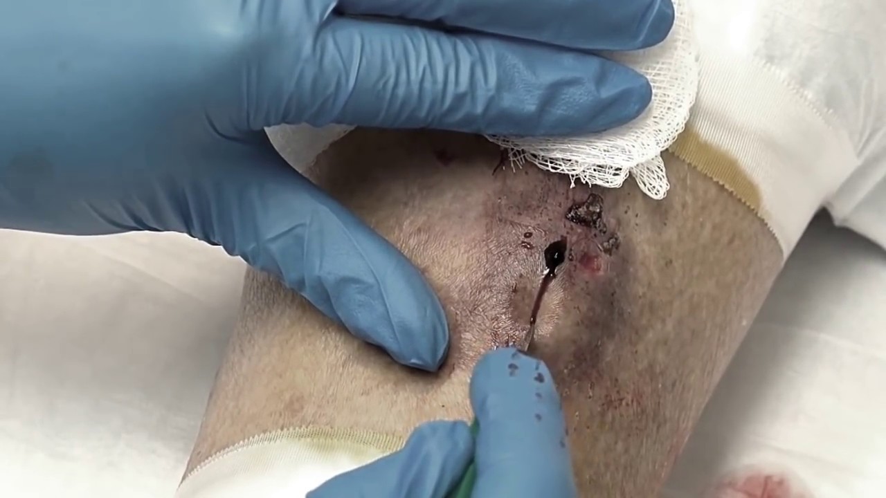Dr. Gilmore’s Biggest Cyst Pops!  Pimple Popping, Zits & Acne