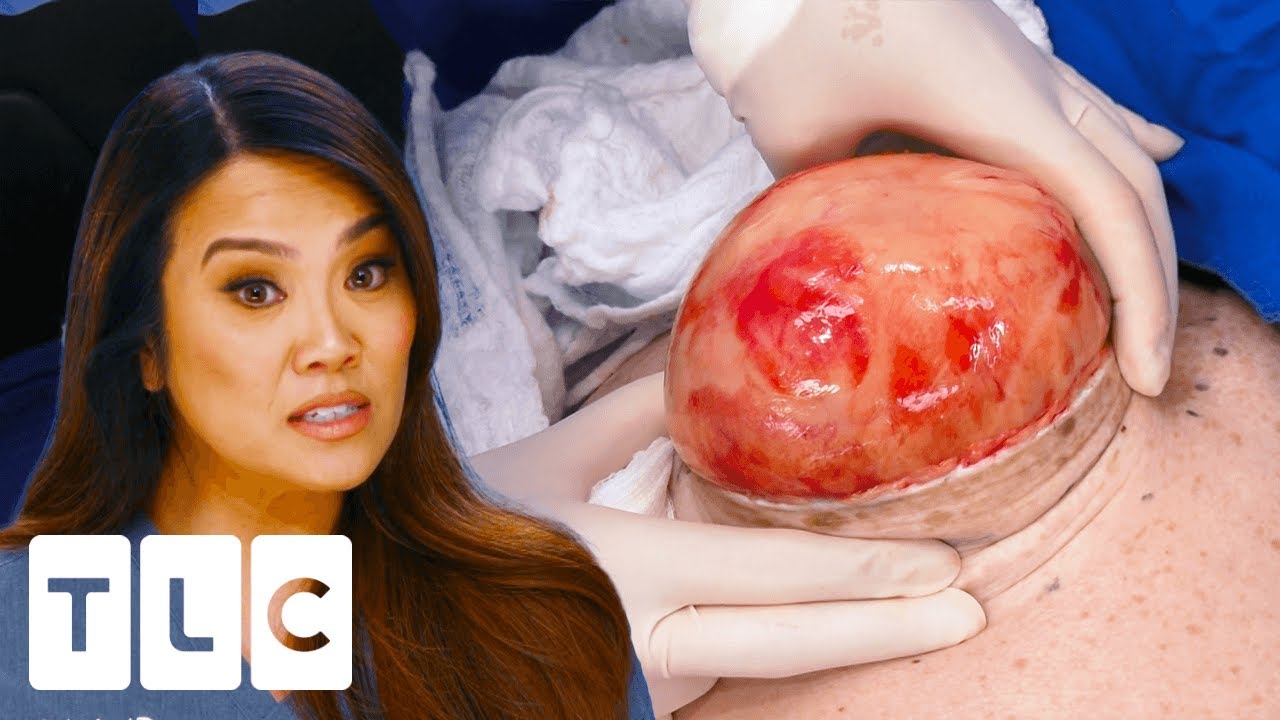 Dr. Lee Celebrates Christmas With A Huge Lipoma Removal I Dr. Pimple Popper