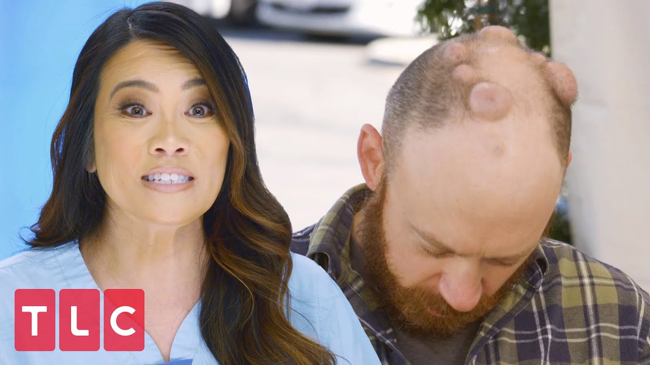 Dr. Lee Extracts ELEVEN Cysts From Man's Head! | Dr. Pimple Popper