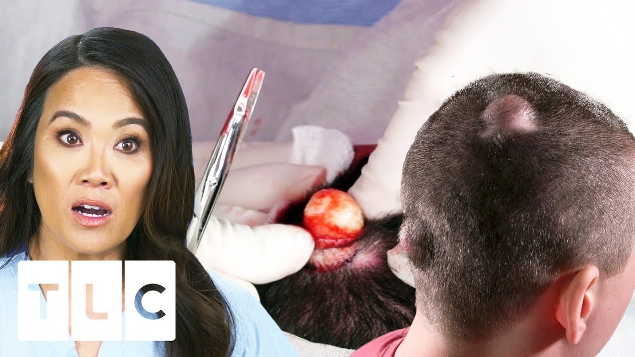 Dr. Lee Gets Sprayed By Explosive Cyst On Man's Head | Dr. Pimple Popper