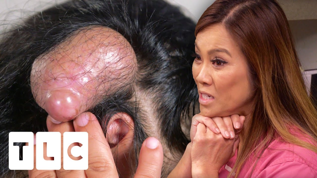 Dr Lee May Have Extracted The Biggest Pillar Cyst She Has Ever Seen! | Dr. Pimple Popper Pop Ups