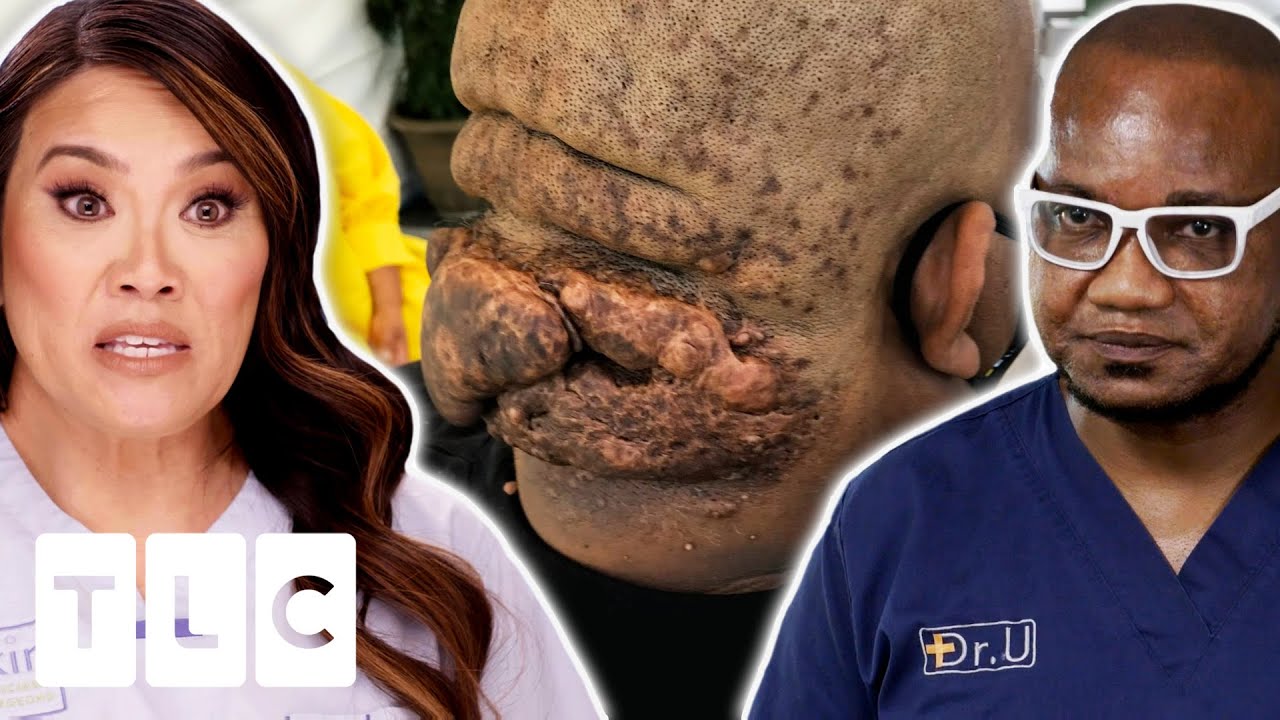 Dr. Lee Needs An Expert's Help To Remove The Bumps On This Man's Head | Dr. Pimple Popper