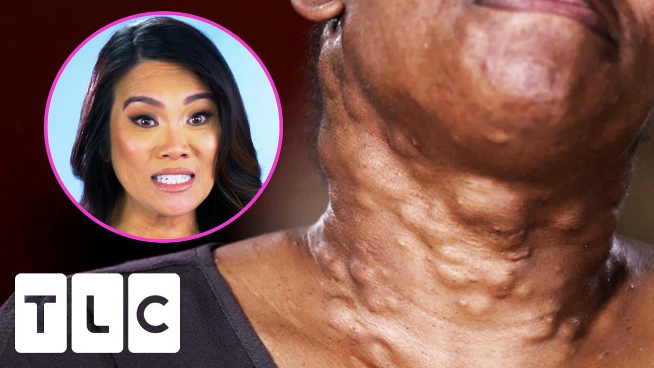Dr. Lee Pops Over 20 Cysts On This Woman's Neck | Dr. Pimple Popper