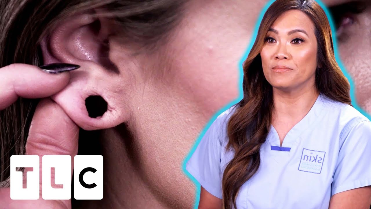 Dr. Lee Reconstructs A Young Woman's Over-Stretched Ears | Dr. Pimple Popper