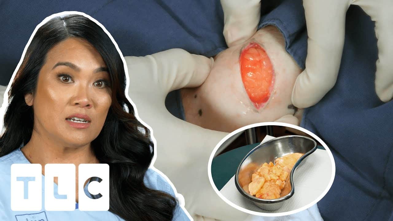 Dr. Lee Removes 16 Lipomas In Life-Threatening Surgery! I Dr. Pimple Popper: Pop Ups