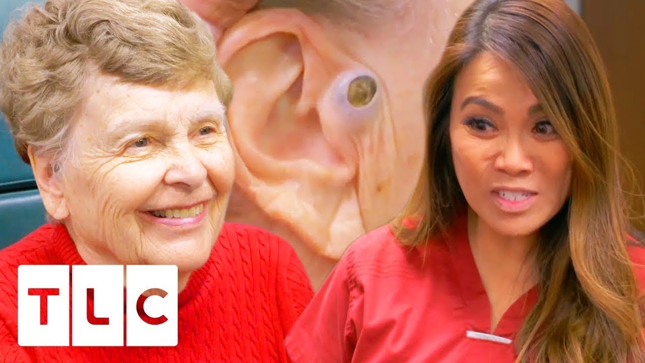 ? Dr. Lee Removes A Massive 55 Year Old Blackhead! | Dr. Pimple Popper