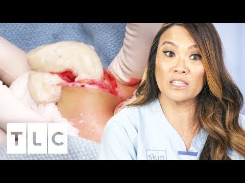 ?Dr. Lee Squeezes Giant Cyst Out Of Young Girls Neck! | Dr. Pimple Popper
