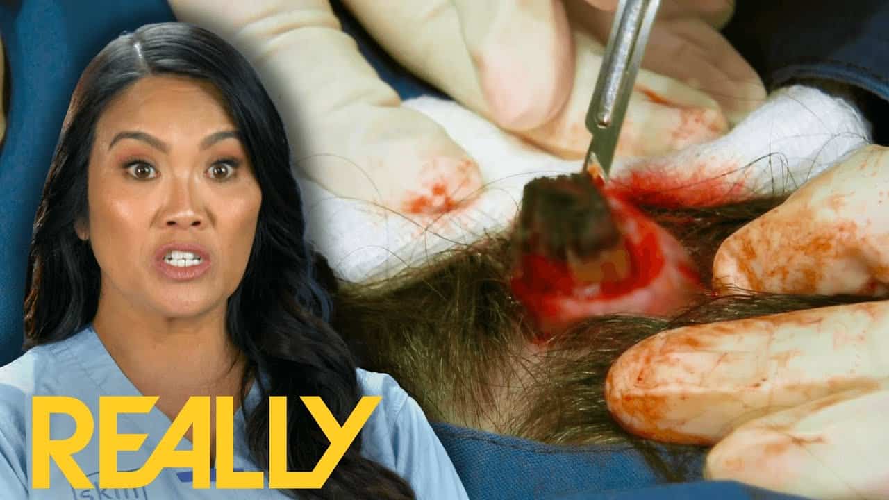 Dr. Lee Tackles 7 Huge Cysts On This Patient’s Head I Dr. Pimple Popper