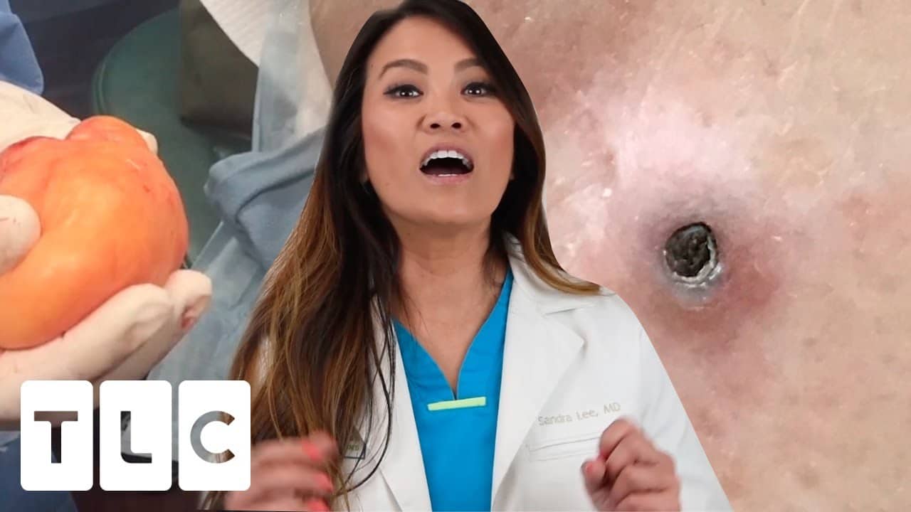 Dr Lee's Most Epic Pop & The Giant Blackhead Under The Skin | Dr. Pimple Popper: This Is Zit