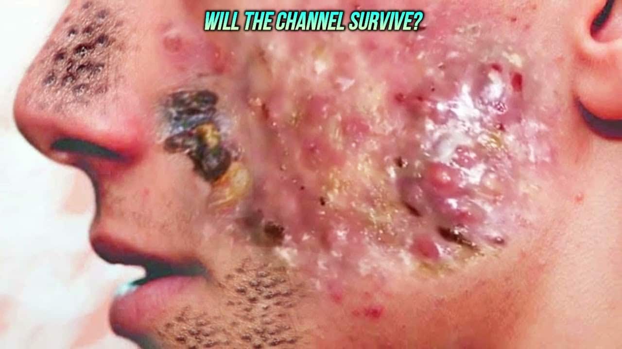 Dr Neak's Pimple Popping video and PHOTOSHOP Thumbnails (Thumb on this video is a picture)