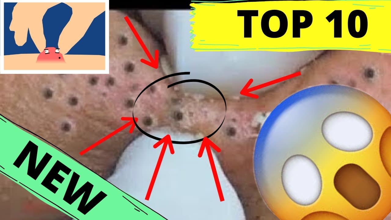 Dr PIMPLE Popped ? – Blackhead removal ???- acne treatment #4