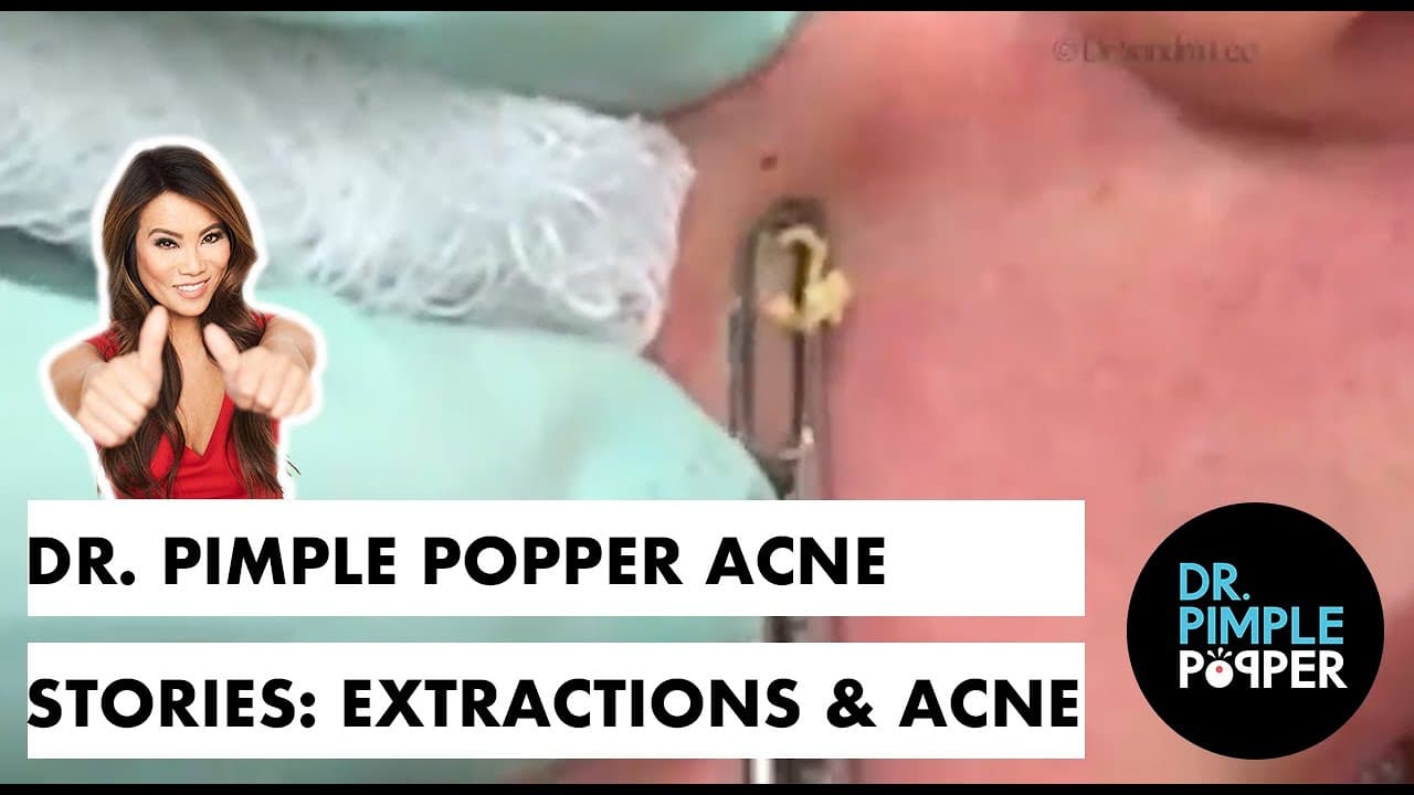 Dr. Pimple Popper Acne Stories: Extractions & Acne