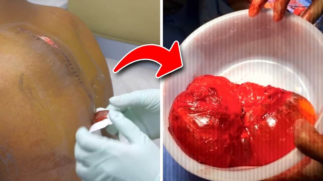 Dr. Pimple Popper Extractions that went WRONG!?