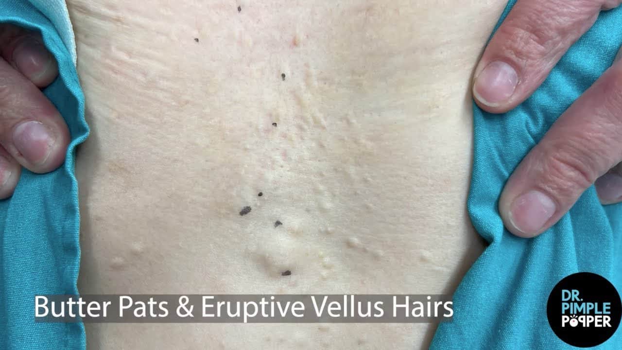 Dr Pimple Popper Mines For Butter Pats & Eruptive Vellus Hairs