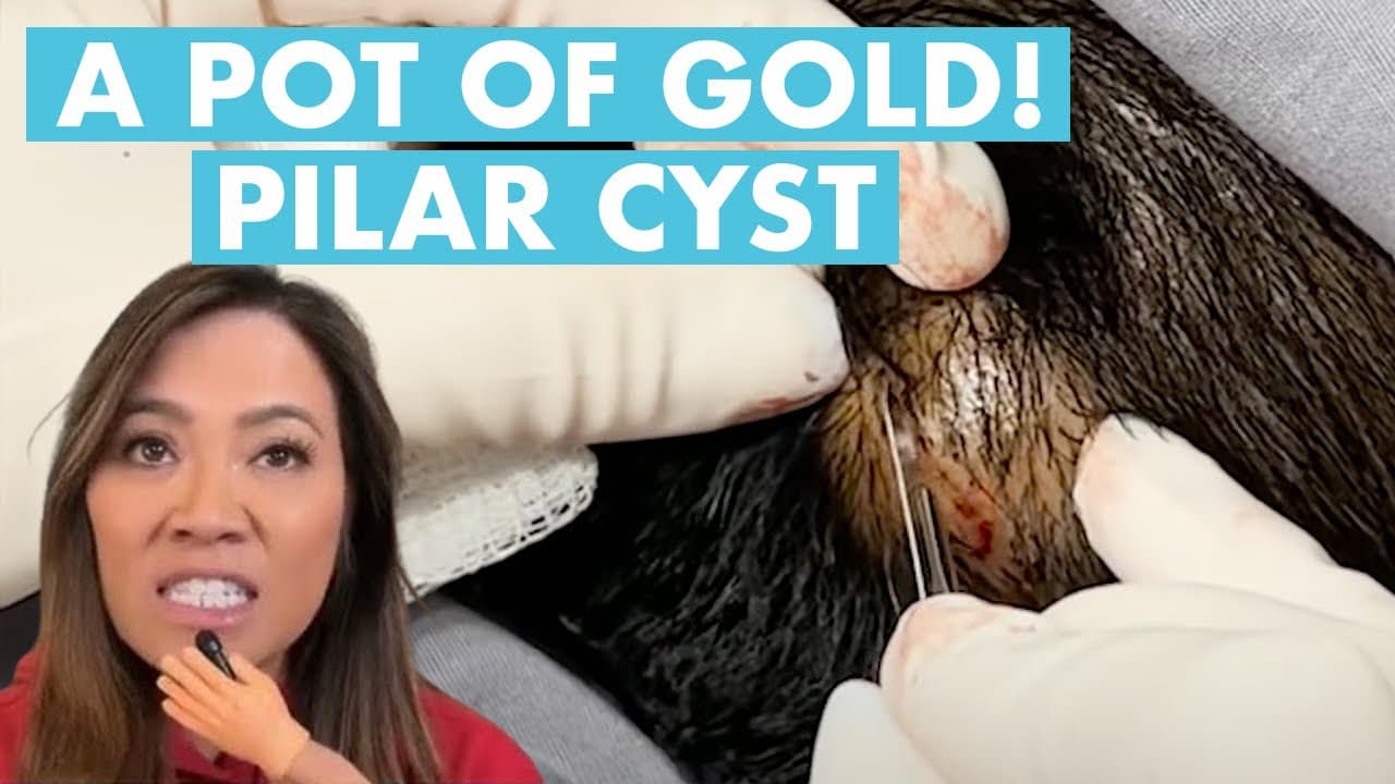 Dr Pimple Popper Opens A Pot Of Gold in a Pilar Cyst!