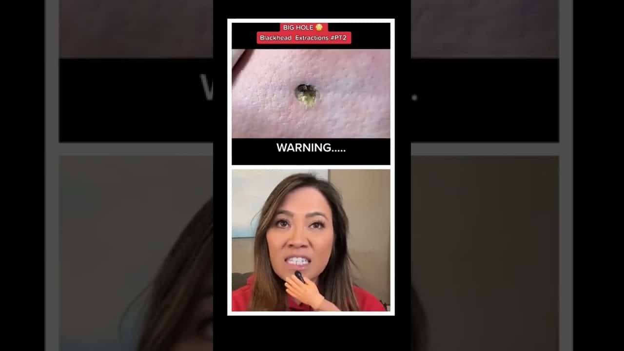 Dr Pimple Popper Reacts to Blackhead Extraction! #shorts #drpimplepopper