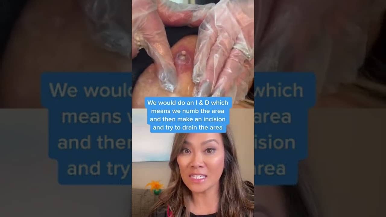 Dr Pimple Popper Reacts to Inflamed Cyst! #shorts #drpimplepopper