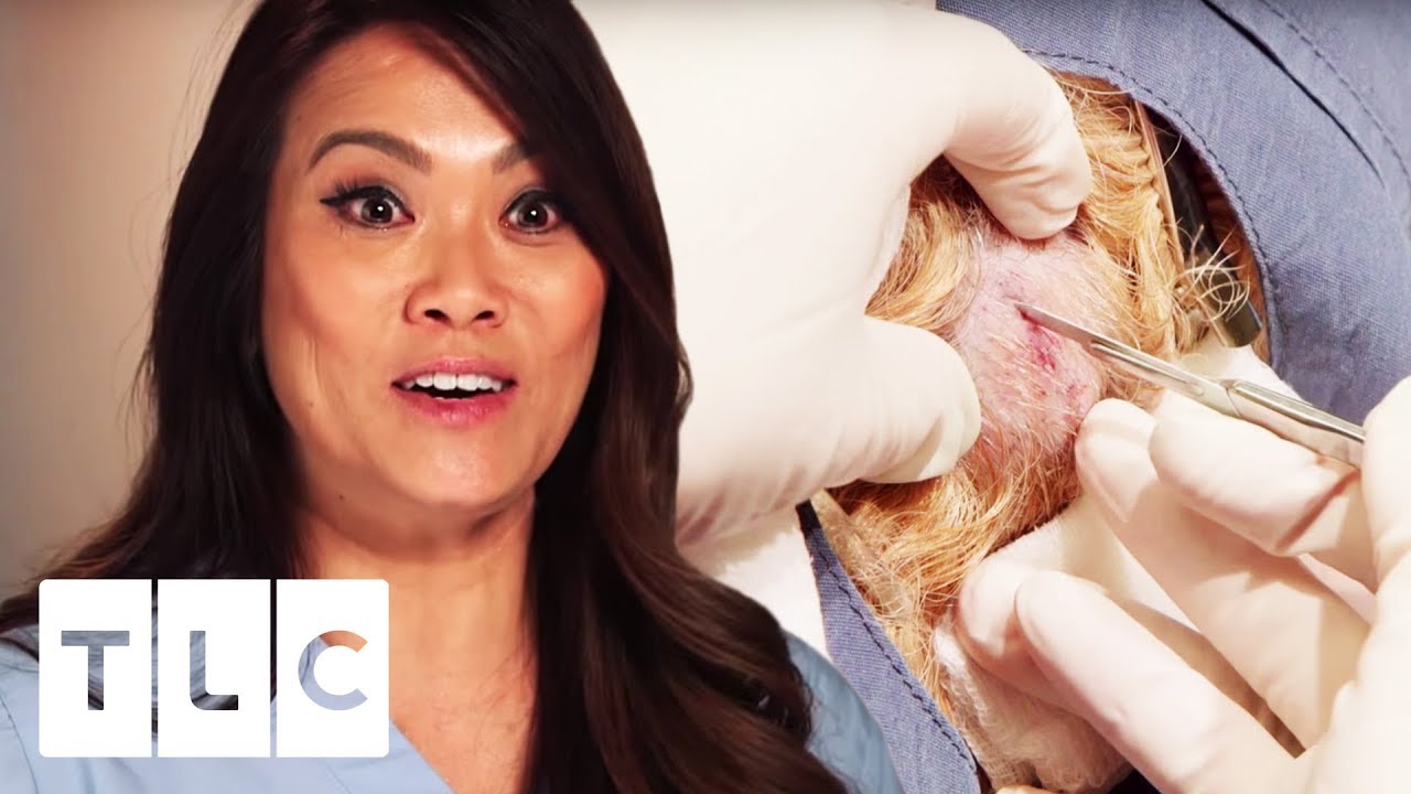 Dr. Pimple Popper | Removing Five 35 Year Old Cysts!