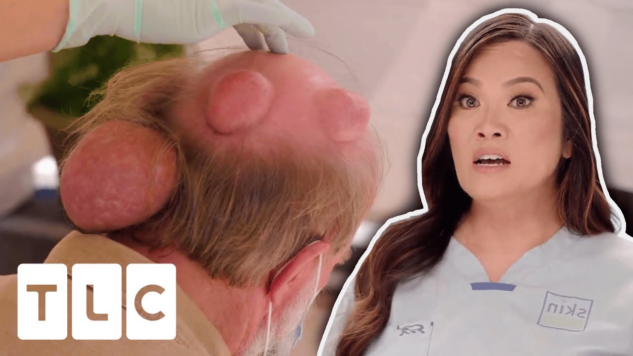 Dr. Pimple Popper Tackles These ENORMOUS Cysts I Dr. Pimple Popper: Pop Ups