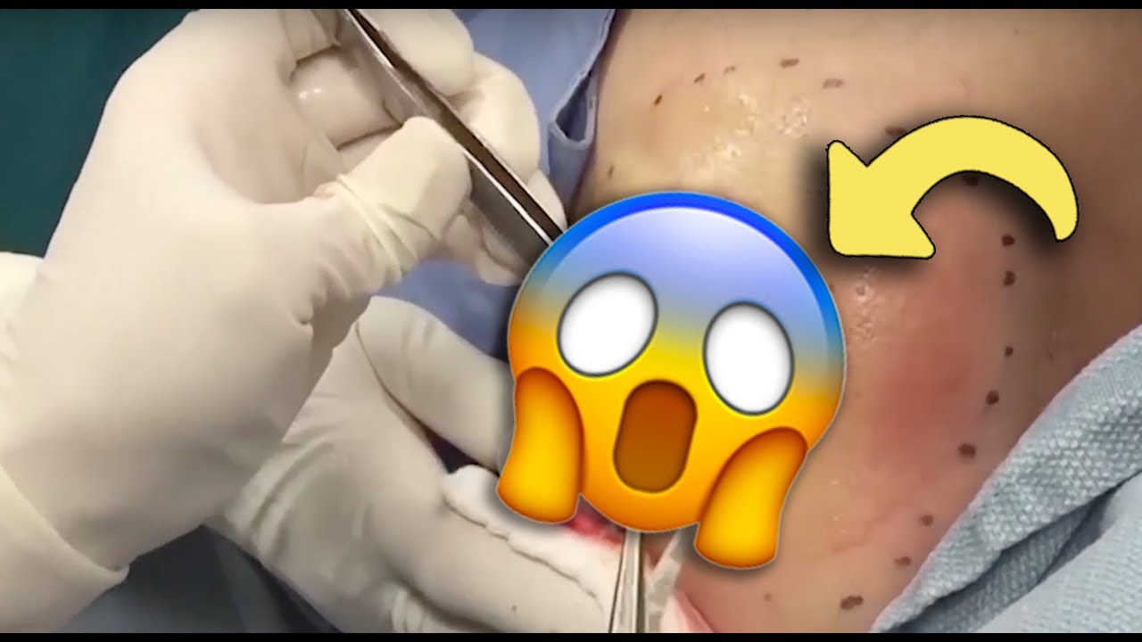 Dr. Pimple Popper’s 10 Most Satisfying Pimple Pops ?