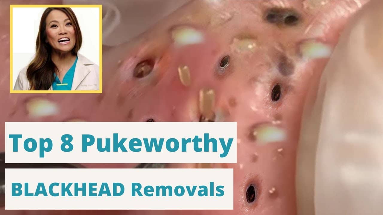 Dr. Pimple Poppers 8 WORST Blackhead Removals – You're not going to want to eat while you watch this