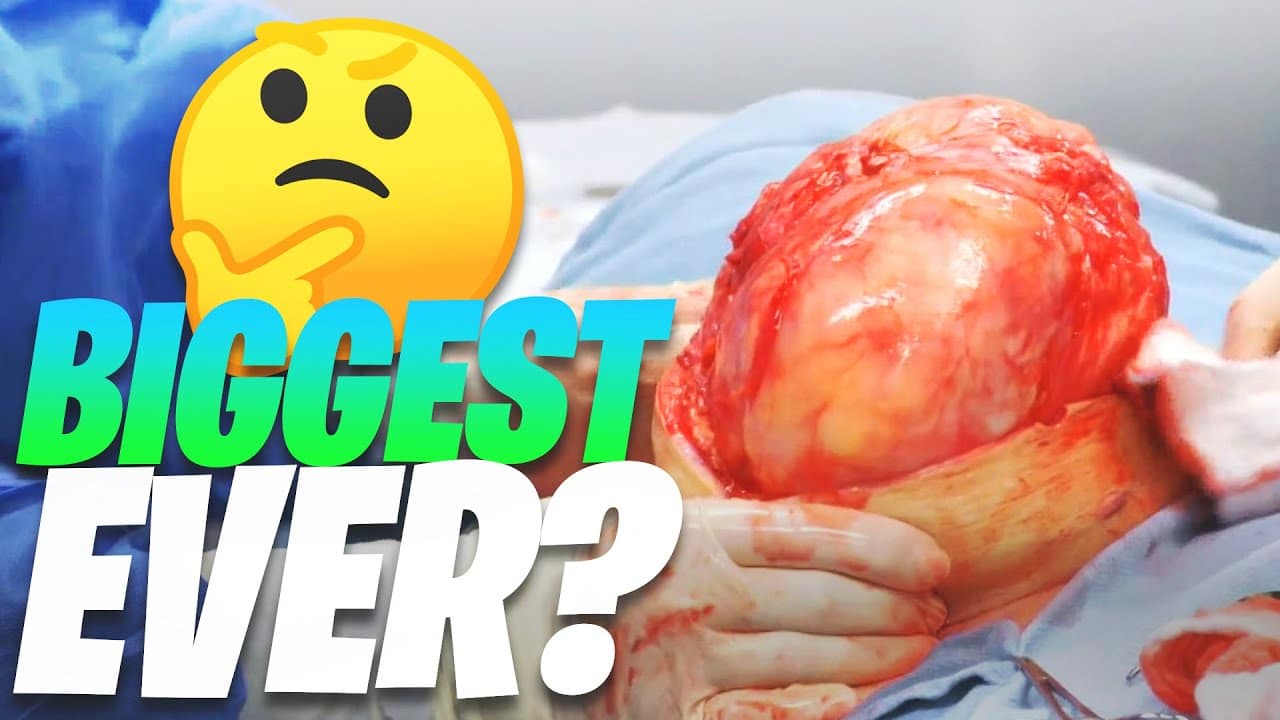 Dr Pimple Popper’s Biggest Cyst Ever “The Standing World Record!”