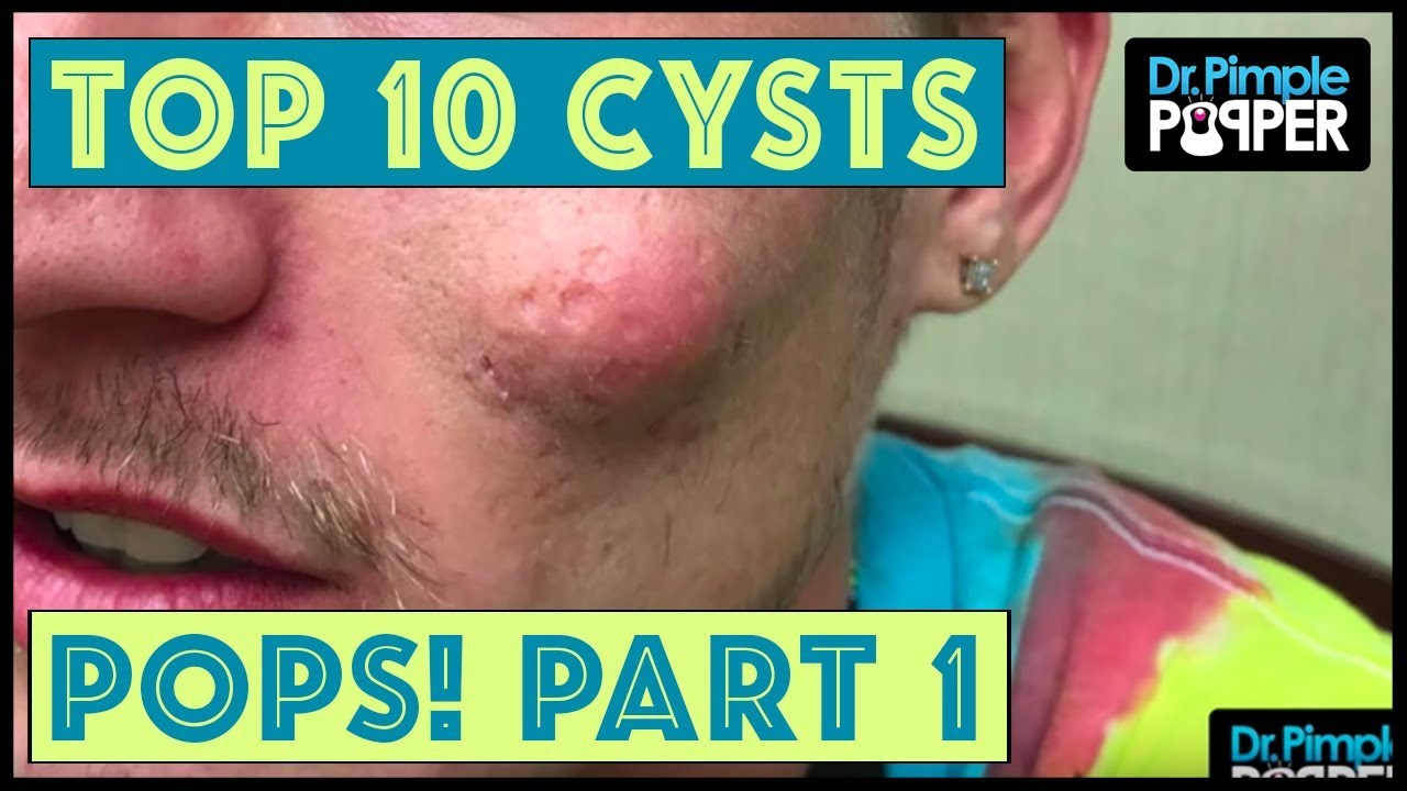 Dr Pimple Popper's Top 10 Cyst POPS of 2017,  Part 1!