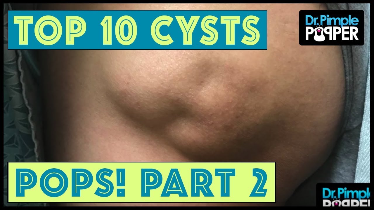 Dr Pimple Popper’s Top 10 Cyst POPS of 2017, Part 2!