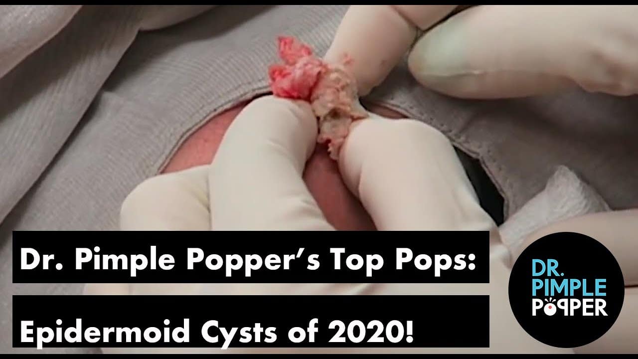 Dr. Pimple Popper’s Top Pops of 2020: Epidermoid Cysts!