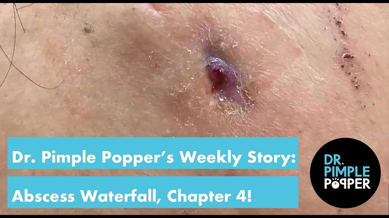 Dr. Pimple Popper’s Weekly Story: Abscess Waterfall, Chapter 4!