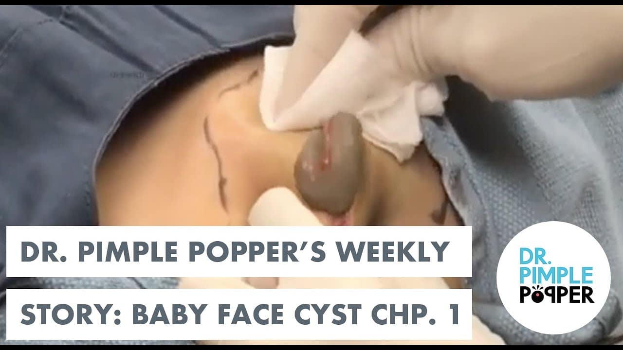 Dr. Pimple Popper's Weekly Story: Baby Face Cyst, Ch 1!