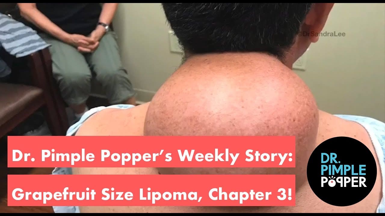 Dr. Pimple Popper's Weekly Story: Grapefruit Size Lipoma, Chapter 3!