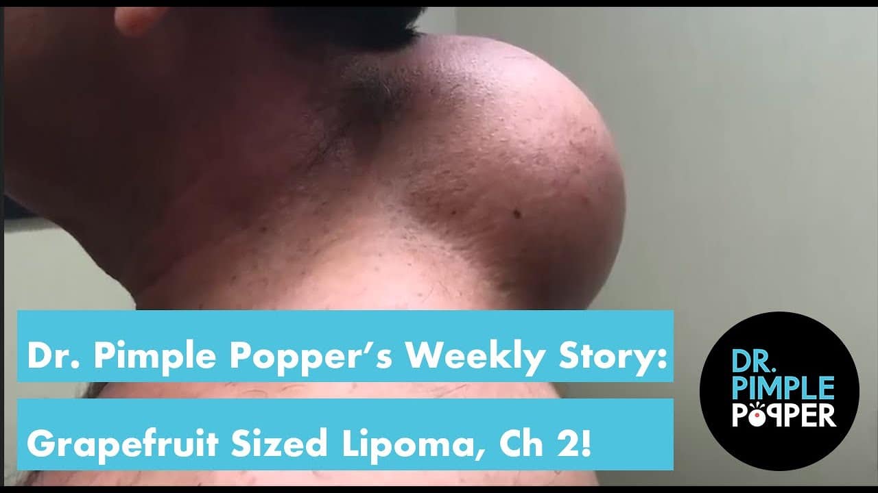 Dr. Pimple Popper’s Weekly Story: Grapefruit Sized Lipoma, Chapter 2!