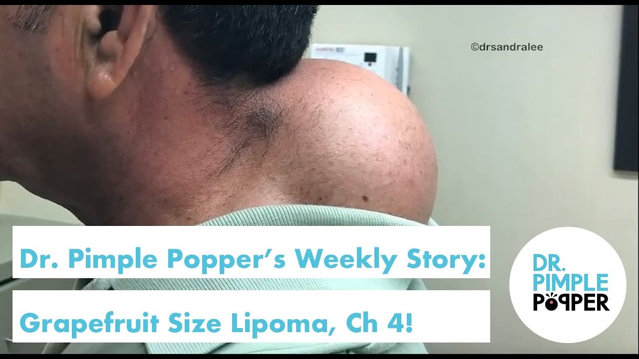 Dr. Pimple Popper's Weekly Story: Grapefruit Size Lipoma Final Chapter!