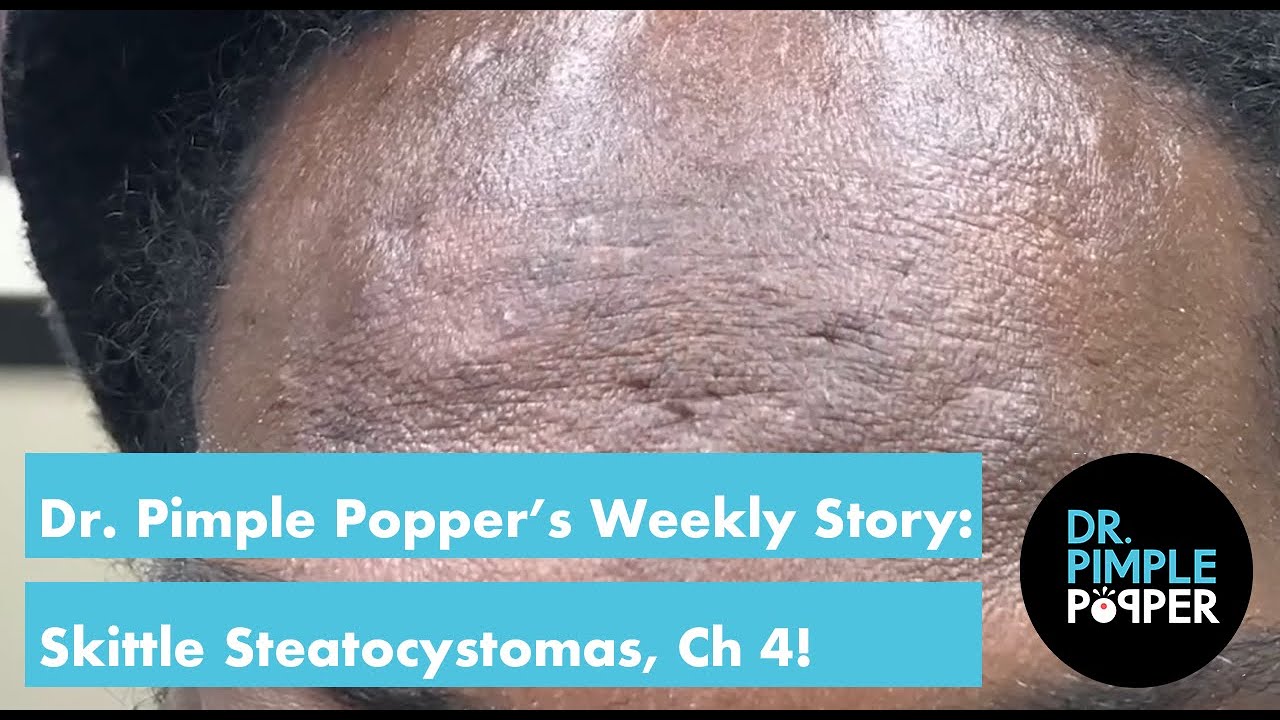 Dr. Pimple Popper's Weekly Story: Skittle Steatocystomas, Chapter 4!