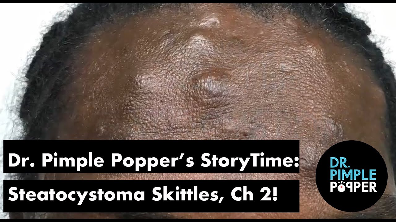 Dr. Pimple Popper's Weekly Story: Steatocystoma Skittles, Chapter 2