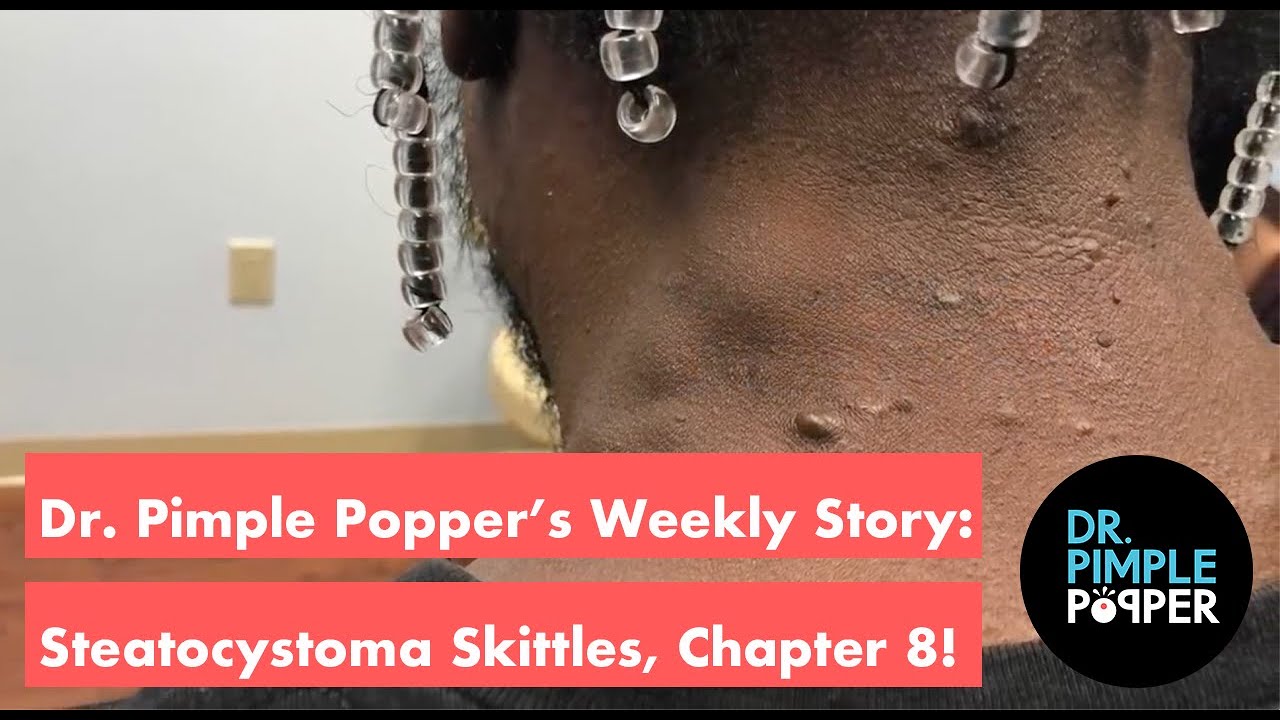 Dr. Pimple Popper’s Weekly Story: Steatocystoma Skittles, Chapter 8!