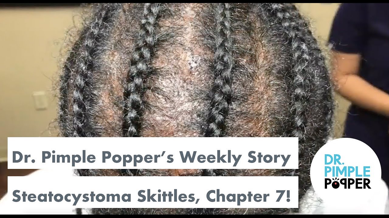 Dr. Pimple Popper's Weekly Story Time: Steatocystoma Skittles, Chapter 7!