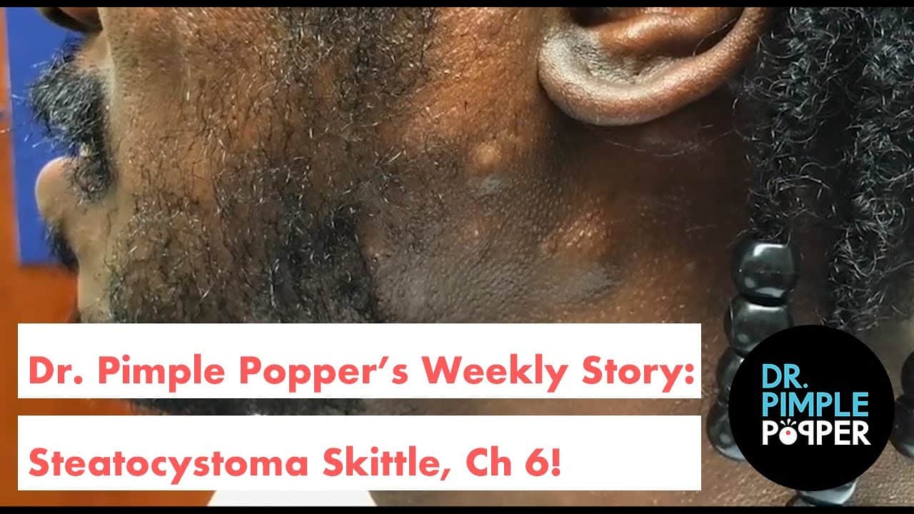 Dr. Pimple Popper’s Weekly Story Time: Steatocystoma Skittles, Ch 6!